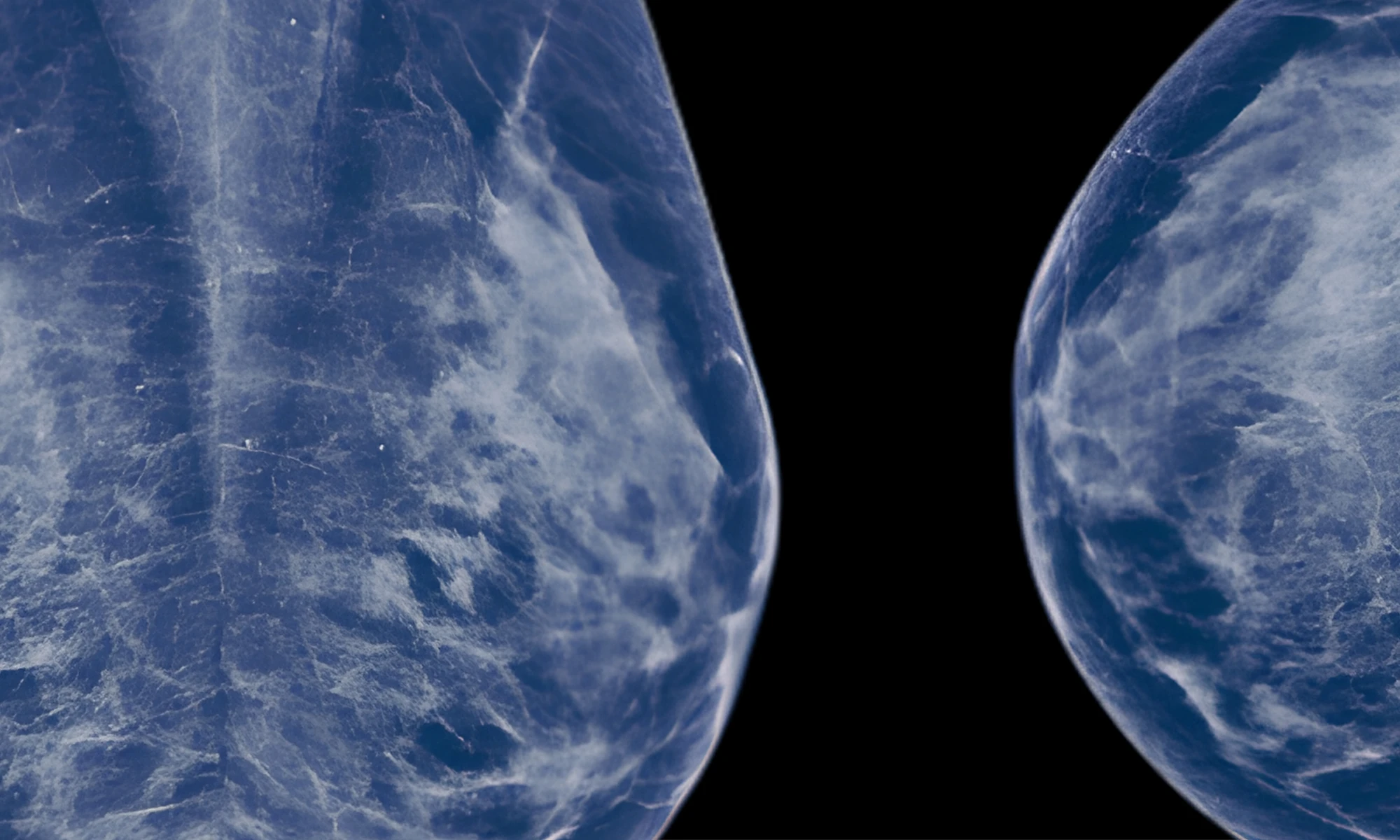 Mammography image displaying breast tissue in shades of blue against a black background. The scan shows internal structures used to detect abnormalities or signs of breast cancer. 
